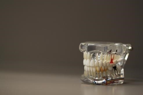 Sodium hypochlorite is used in clinical dental root canal therapy